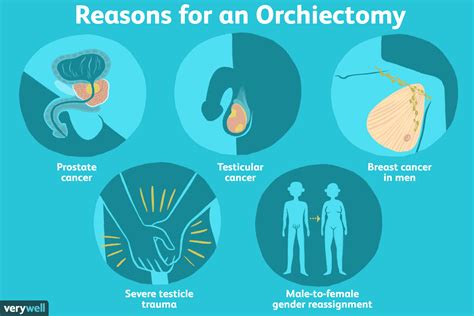 An endocrinologist may recommend an <b>orchiectomy</b>, which involves removal of the testicles, to considerably reduce the production of testosterone. . Voluntary orchiectomy